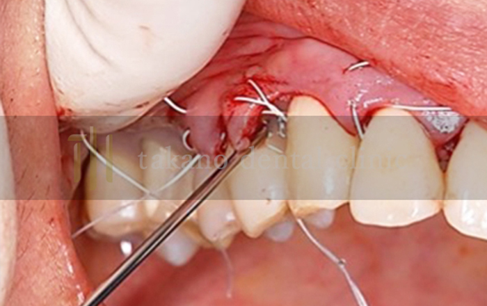 歯周組織再生材料