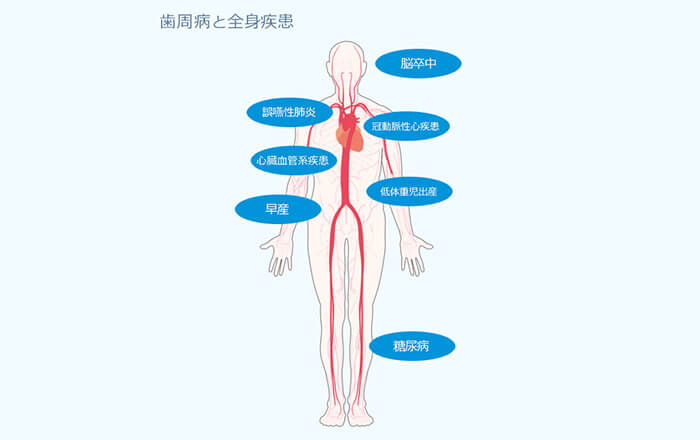 歯周病